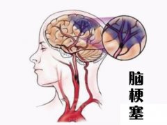 養(yǎng)成好的生活習慣，能夠有效預防腦梗塞